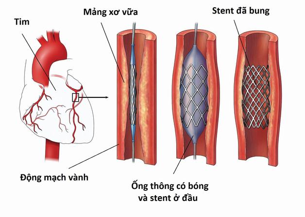 Co thắt động mạch vành: Bệnh lý nguy hiểm