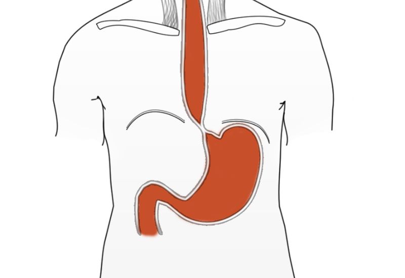 Co thắt tâm vị nuốt nghẹn và “tiêu chuẩn vàng” trong chẩn đoán