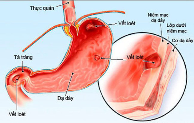 Có thể chẩn đoán ung thư dạ dày giai đoạn sớm không?