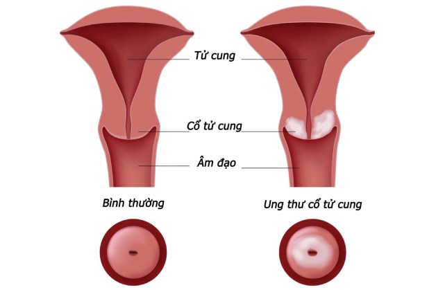 Cơ thể có dấu hiệu này nên đi khám sàng lọc ung thư cổ tử cung ngay