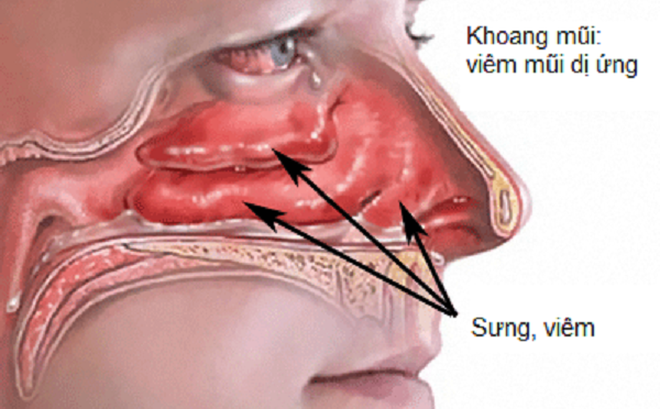 Có thể điều trị viêm mũi dị ứng dứt điểm hay không?