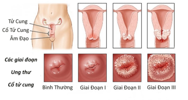 Có thể phát hiện sớm ung thư cổ tử cung được không?