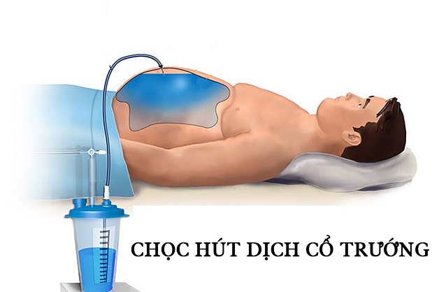 Cổ trướng: Nguyên nhân, triệu chứng và chẩn đoán