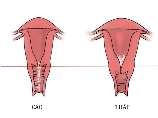 Cổ tử cung cao và những ảnh hưởng tới khả năng mang thai ở nữ giới