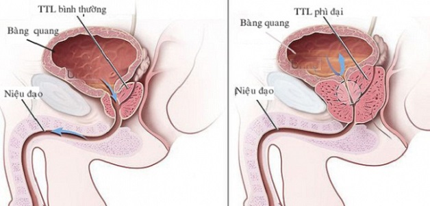 Cổ tử cung phì đại là gì? và ảnh hưởng sức khỏe như thế nào?