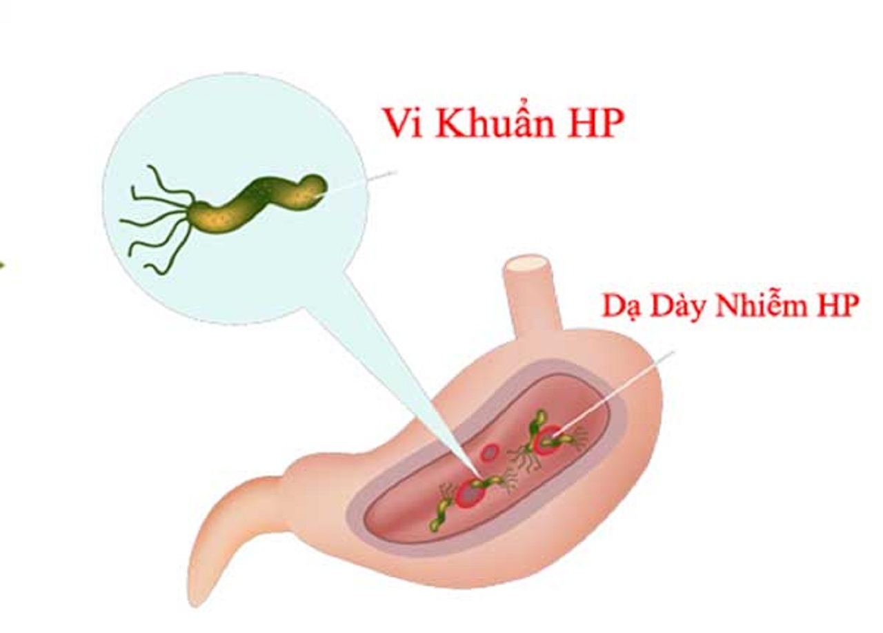 Có vi khuẩn Hp trong dạ dày: triệu chứng và biến chứng