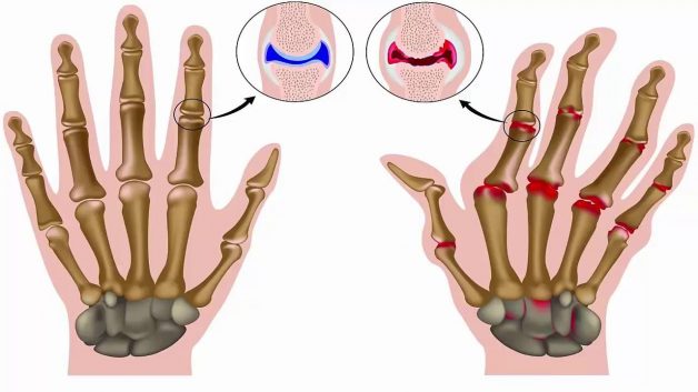 Coi chừng hậu quả bệnh viêm khớp dạng thấp