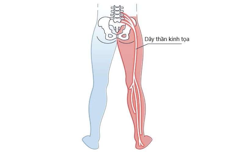 Cơn đau thần kinh tọa: Nguyên nhân xuất hiện, biểu hiện