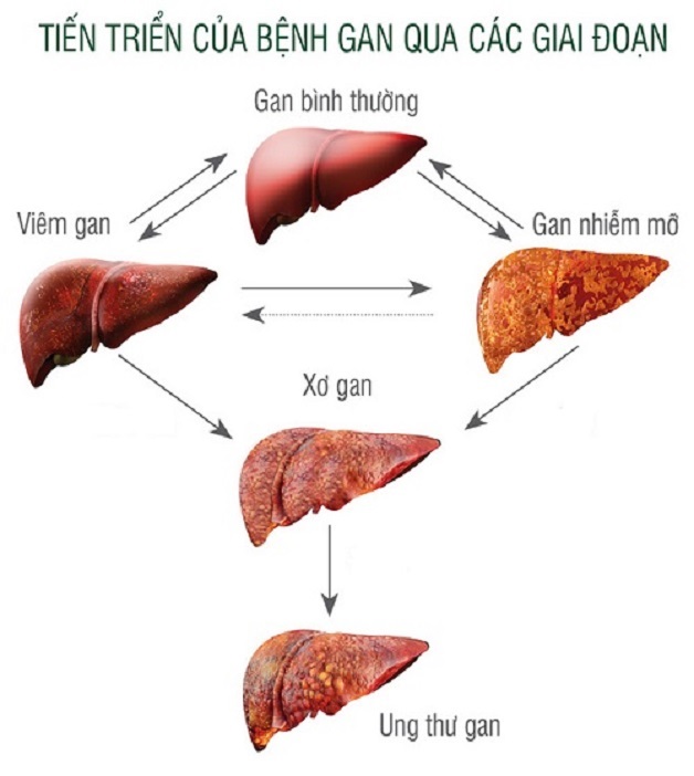 Xơ gan, ung thư gan phát triển từ "cột mốc" gan nhiễm mỡ