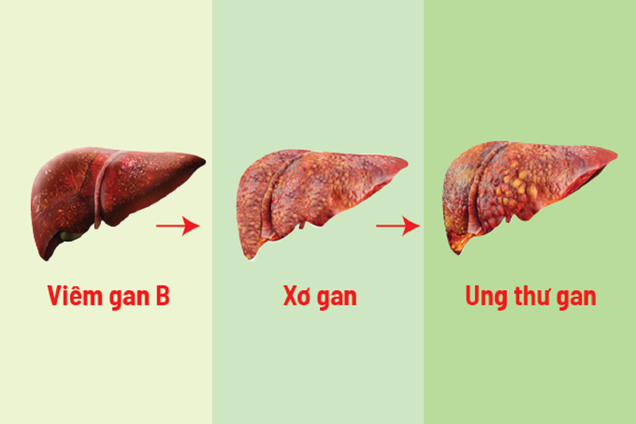 Con đường từ viêm gan B chuyển sang xơ gan, ung thư gan