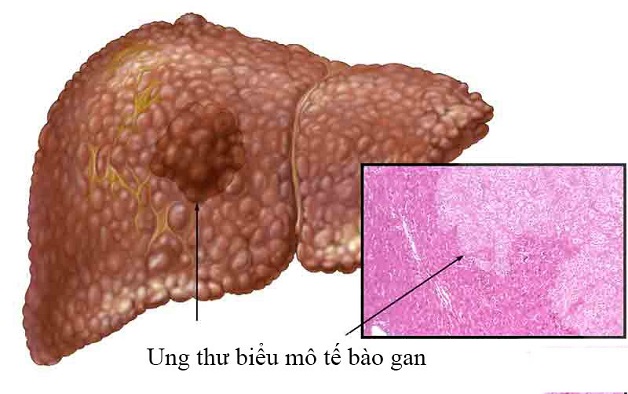 Con đường từ viêm gan B chuyển sang xơ gan, ung thư gan