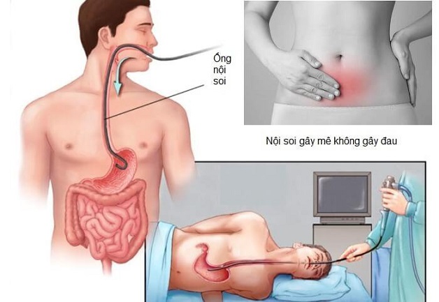 Công nghệ nội soi không đau – Bước tiến lớn của y học