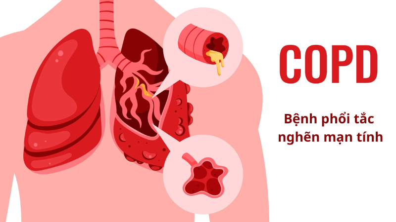 Copd là bệnh gì, nguyên nhân, triệu chứng và cách điều trị