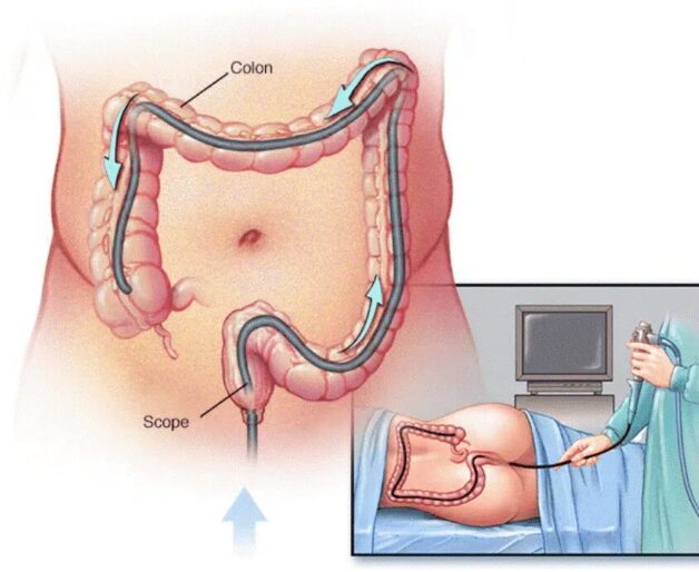 Crohn bệnh học: Nguyên nhân, triệu chứng và điều trị