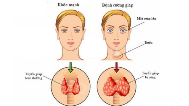 Cường tuyến giáp: Nguyên nhân, triệu chứng