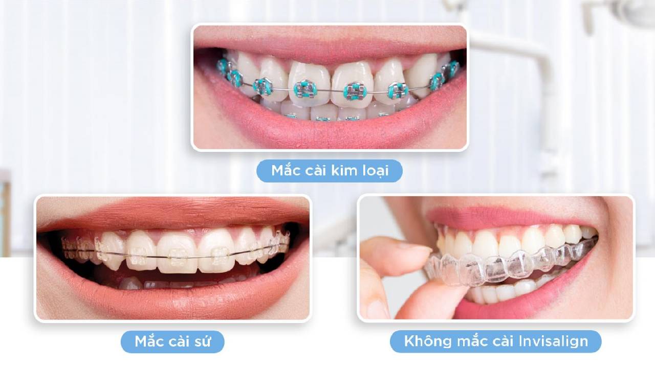 Đa dạng phương pháp niềng răng tại Hà Nội