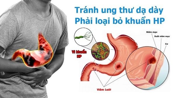 Dạ dày chứa vi khuẩn HP có nguy hiểm không?