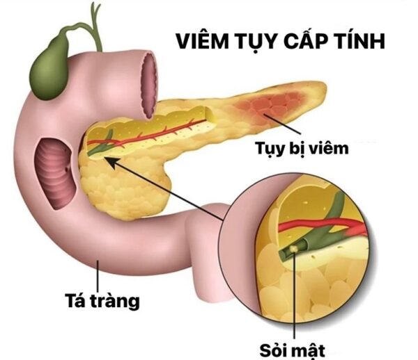 Đặc điểm cơn đau viêm tụy cấp 