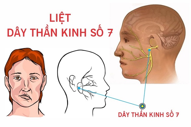 Đặc điểm của liệt dây thần kinh số 7 ngoại biên