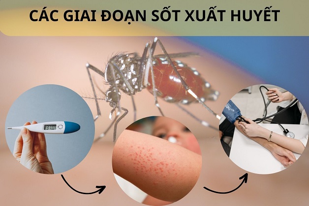 Đặc điểm giai đoạn 2 của sốt xuất huyết