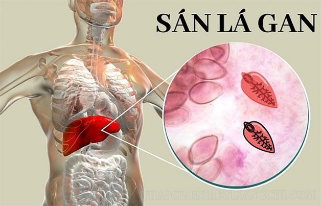 Đặc điểm sán lá gan và các giai đoạn bệnh