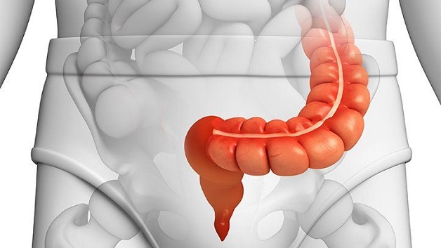 Đại tràng sigma có polyp: Cách chẩn đoán và điều trị