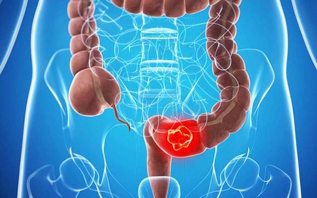 Đại tràng sigma và những bệnh lý thường gặp