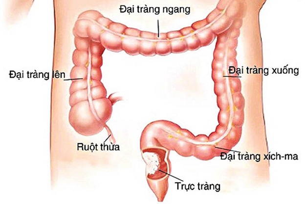 Đại trực tràng là gì? Các bệnh lý thường gặp ở đại trực tràng