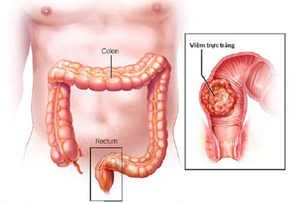 Đại trực tràng là gì? Các bệnh lý thường gặp ở đại trực tràng