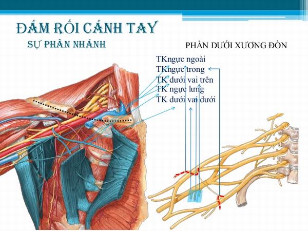 Đám rối thần kinh cánh tay thường gặp tổn thương gì?