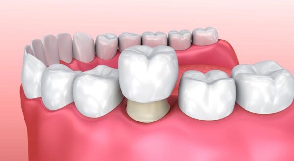 Dành cho ai muốn biết bọc răng sứ giá bao nhiêu