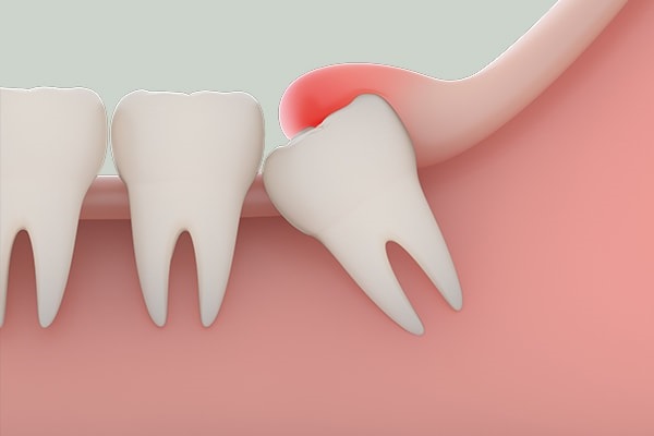 Dành cho ai thắc mắc răng khôn có nên nhổ