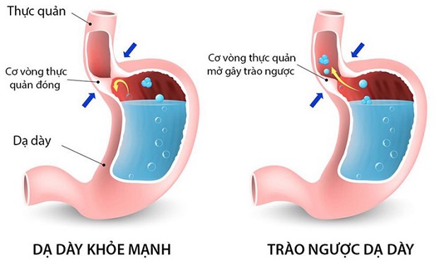 Đánh giá các cấp độ trào ngược dạ dày