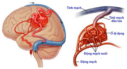 Đánh giá nguy cơ đột quỵ từ dị dạng mạch máu não