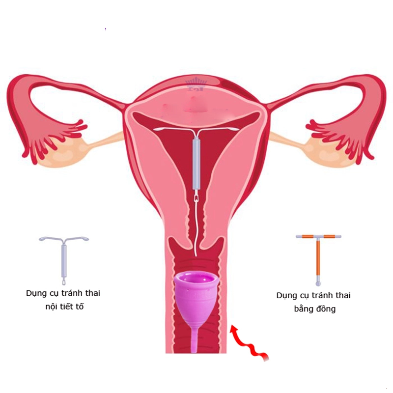 Đặt vòng có nên dùng cốc nguyệt san?