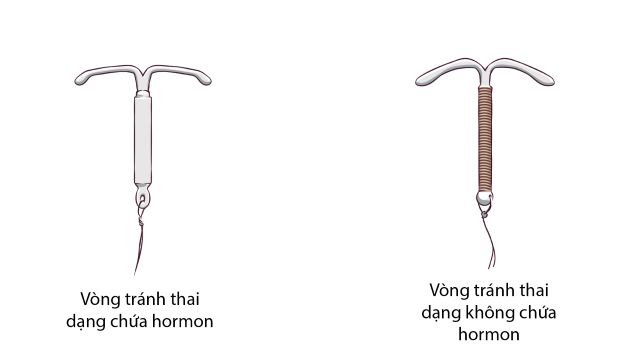 Đặt vòng tránh thai IUD và những thông tin cần biết