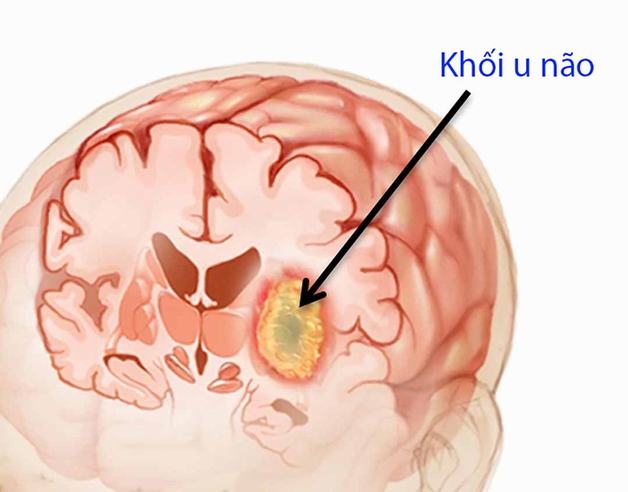 Đau 1 nửa đầu bên phải xuất phát do đâu?