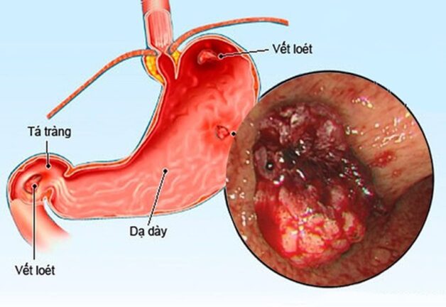 Đau dạ dày miệng đắng- Nguyên nhân, cách xử lý