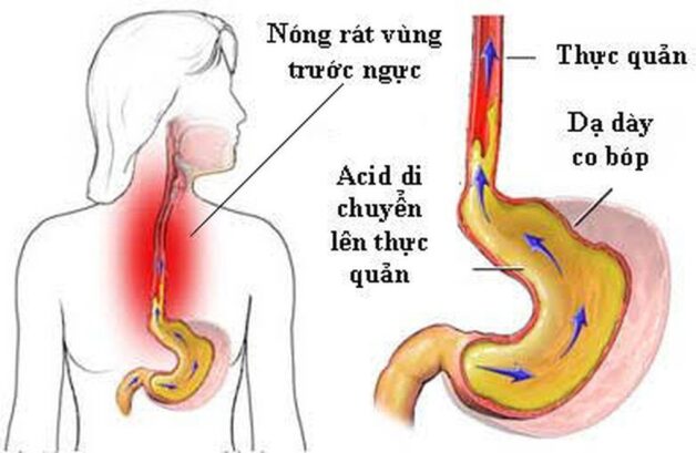 Đau dạ dày ợ hơi: Nguyên nhân, triệu chứng