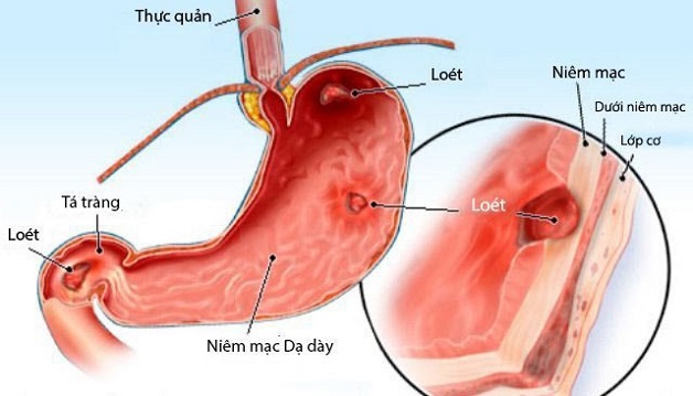 Đau dạ dày tá tràng và những điều bạn cần biết