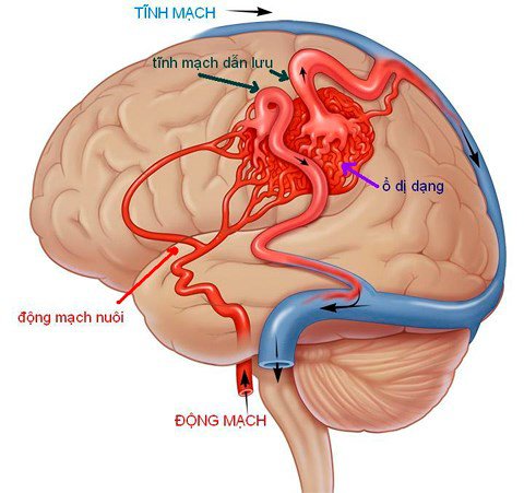 Đau đầu kéo dài cẩn thận bạn có thể mắc phải