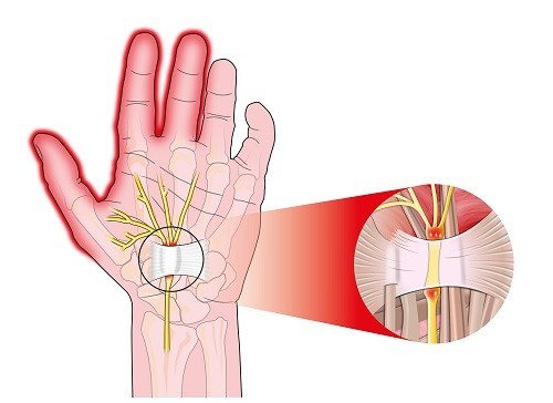 Đau đầu ngón tay: nguyên nhân, chẩn đoán và cách điều trị