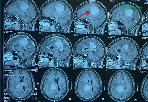 Đau đầu trong u não có gì khác biệt?