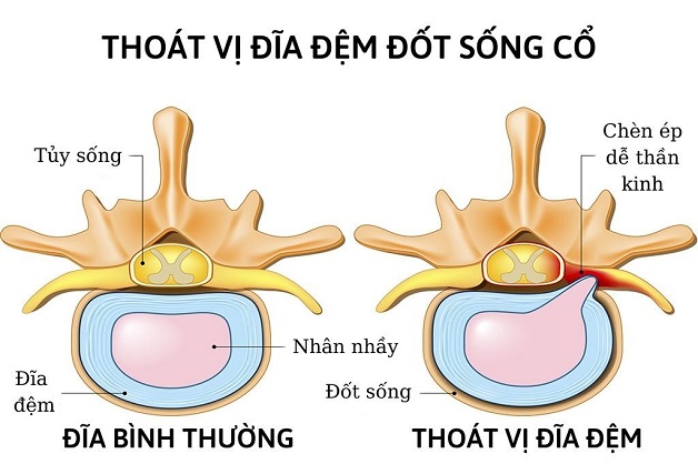 Đau dây thần kinh ở cổ báo hiệu bệnh gì?