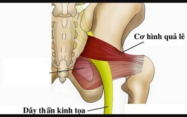 Đau dây thần kinh tọa – nguyên nhân, triệu chứng