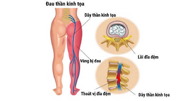 Đau dây thần kinh tọa: Những điều cần biết