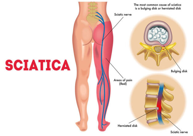 Đau dây thần kinh tọa triệu chứng đặc trưng cần biết