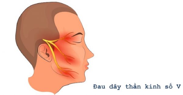 Đau dữ dội vùng mặt coi chừng viêm dây thần kinh số 5