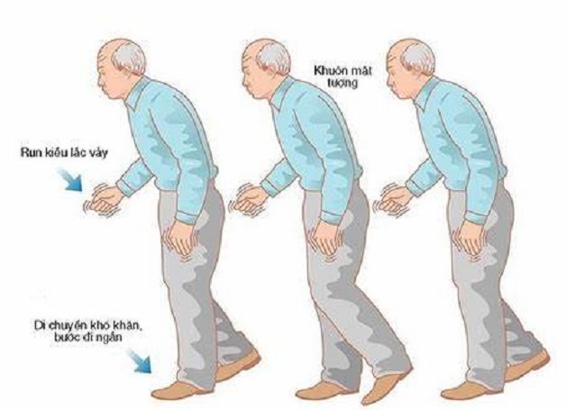 Dấu hiệu bệnh parkinson theo từng giai đoạn