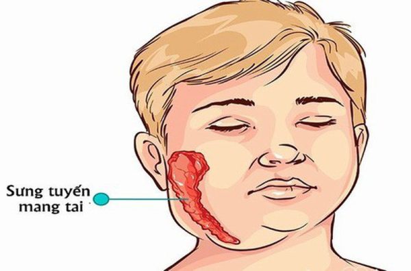 Dấu hiệu bệnh quai bị ở trẻ em